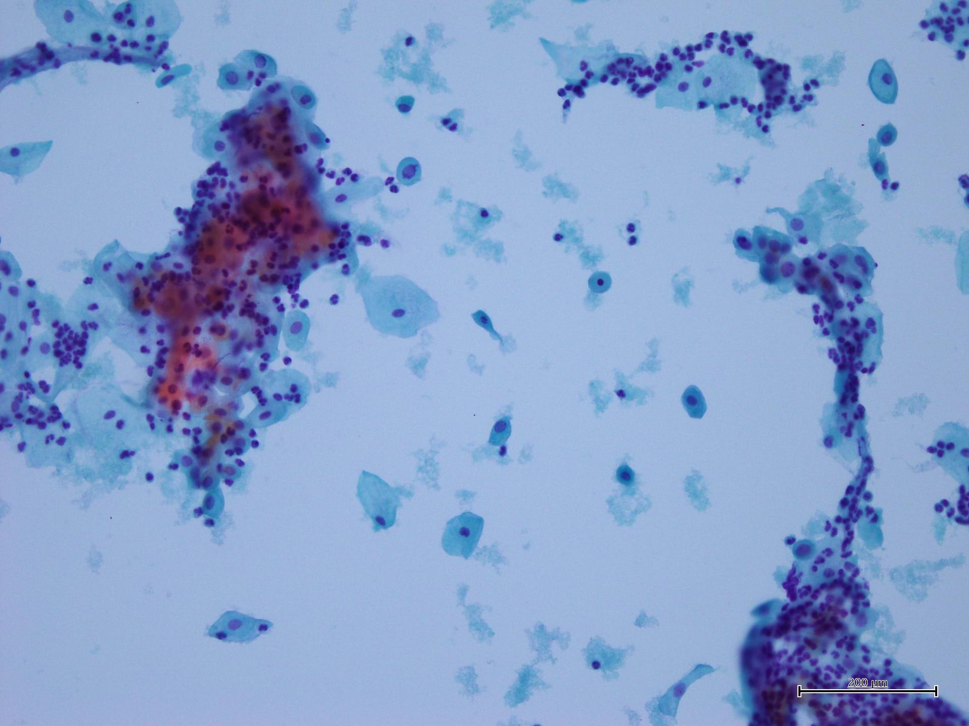Cytopath Ematossilina<br />Harris